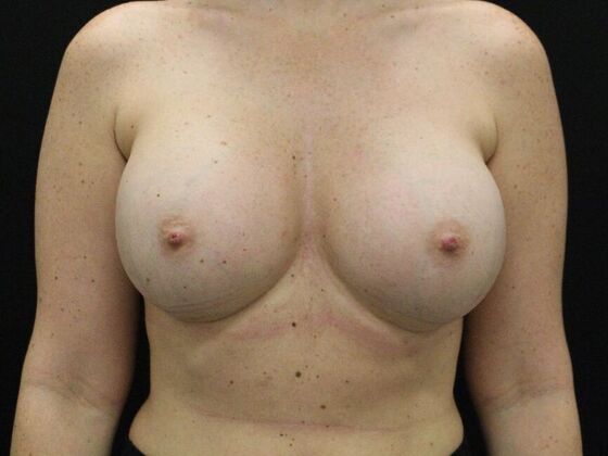 Breast Augmentation Case 113 - After
