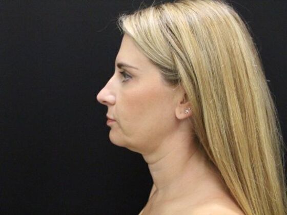 Face & Neck Lifts: Case 39 - Before