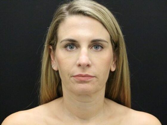 Face & Neck Lifts: Case 39 - Before