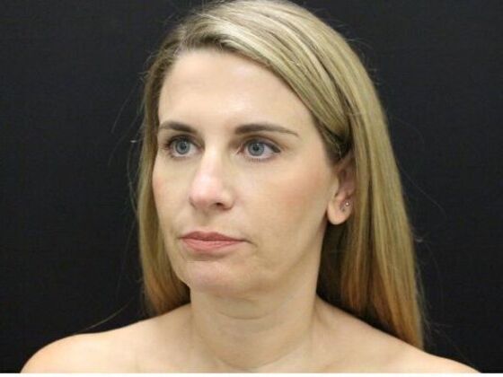 Face & Neck Lifts: Case 39 - Before