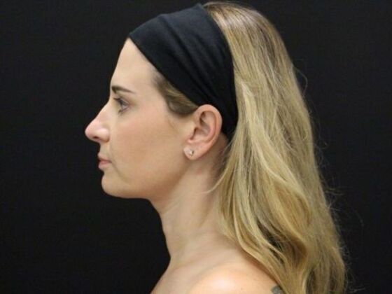 Face & Neck Lifts: Case 39 - After