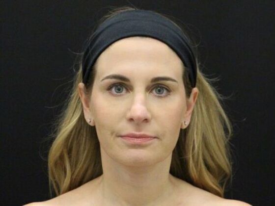 Face & Neck Lifts: Case 39 - After