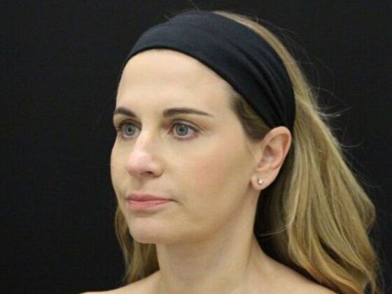 Face & Neck Lifts: Case 39 - After