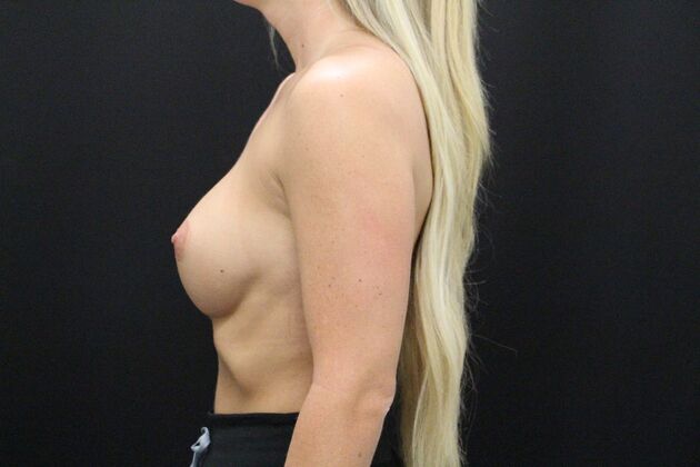 Breast Augmentation Exchange/Revision: Case 20 - Before