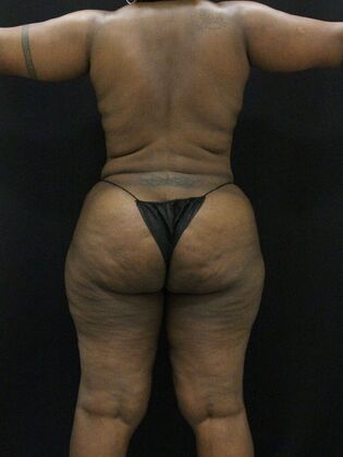 Tummy Tuck: Case 37 - After