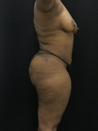 Tummy Tuck: Case 37 - After