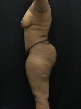 Tummy Tuck: Case 37 - After