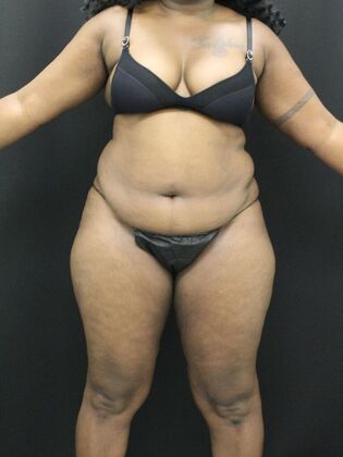 Tummy Tuck Case 37 - Before