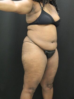 Tummy Tuck: Case 37 - Before