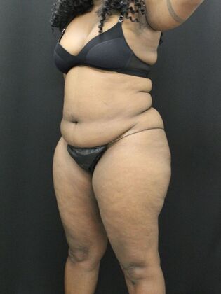 Tummy Tuck: Case 37 - Before