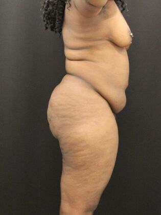 Tummy Tuck: Case 37 - Before