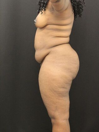 Tummy Tuck: Case 37 - Before