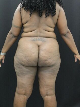 Tummy Tuck: Case 37 - Before