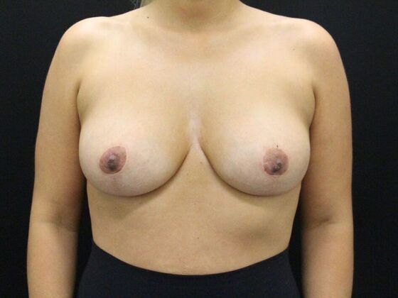 Breast Reduction & Lift Case 16 - After