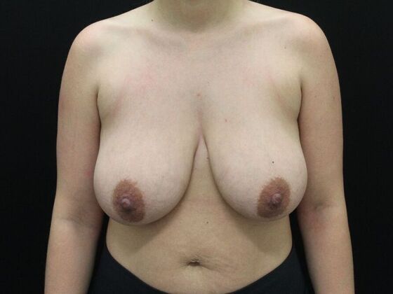 Breast Reduction & Lift Case 16 - Before