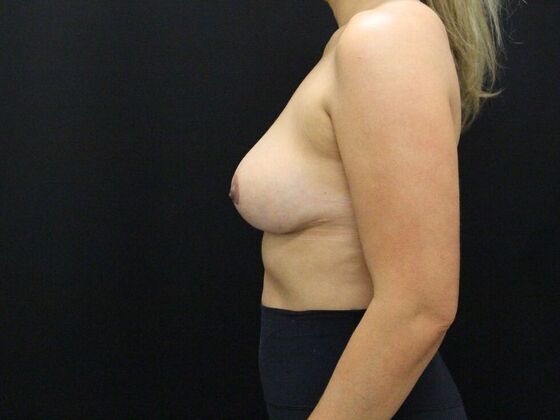 Breast Lift & Breast Lift Augmentation: Case 29 - After