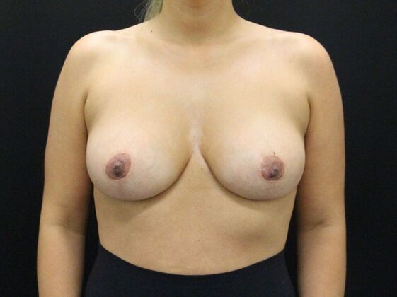 Breast Lift & Breast Lift Augmentation Case 29 - After