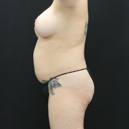 Tummy Tuck: Case 65 - Before