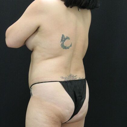 Tummy Tuck: Case 65 - Before