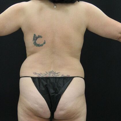 Tummy Tuck: Case 65 - Before