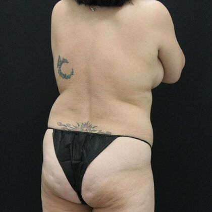 Tummy Tuck: Case 65 - Before