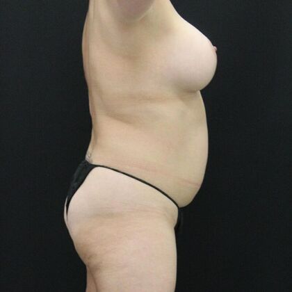 Tummy Tuck: Case 65 - Before