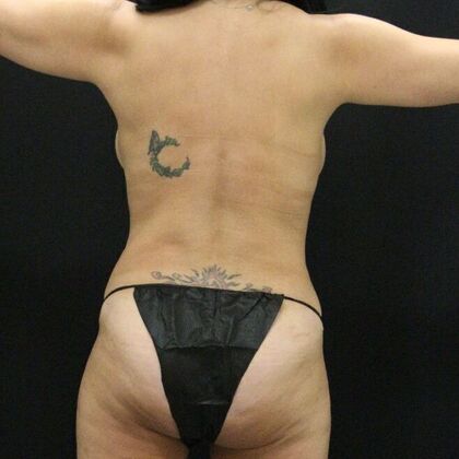 Tummy Tuck: Case 65 - After