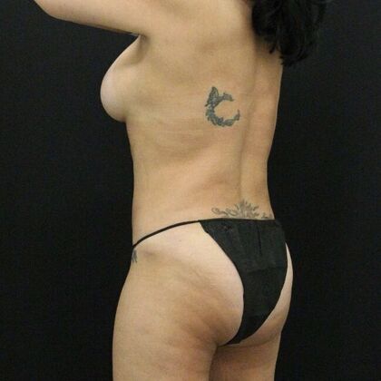 Tummy Tuck: Case 65 - After