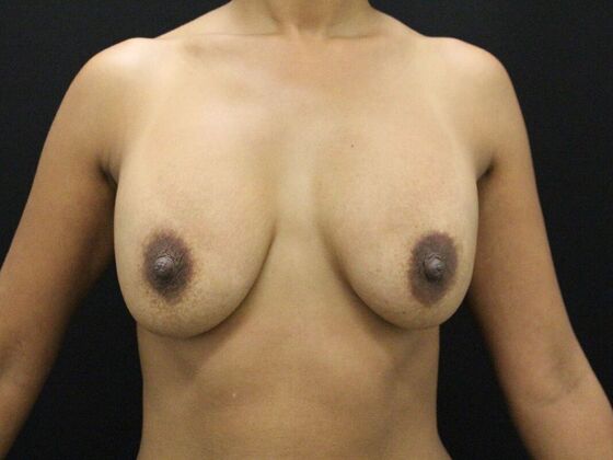 Breast Lift/Breast Lift Augmentation Case 53 - Before