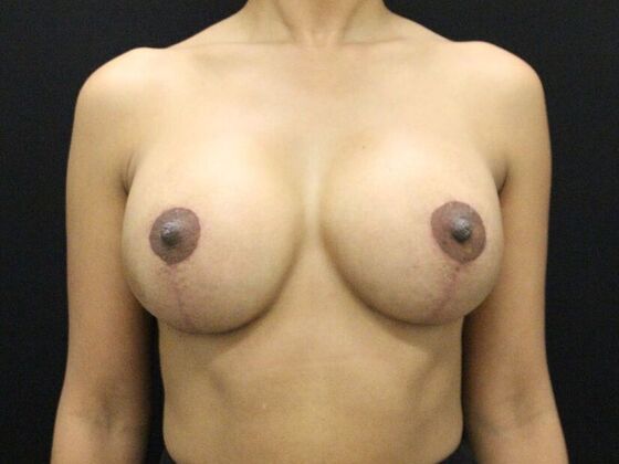 Breast Lift/Breast Lift Augmentation Case 53 - After