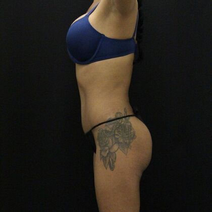 Tummy Tuck: Case 66 - After