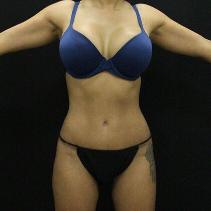 Liposuction Case 29 - After