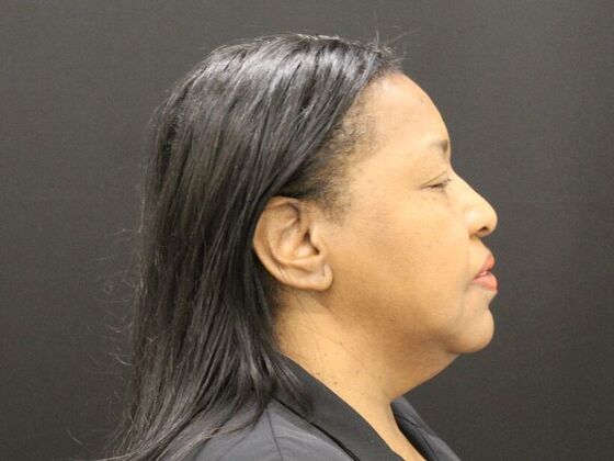 Face & Neck Lifts: Case 40 - Before