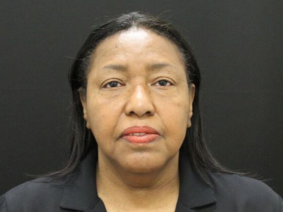 Face & Neck Lifts Case 40 - Before