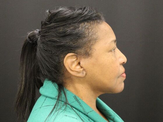 Face & Neck Lifts: Case 40 - After