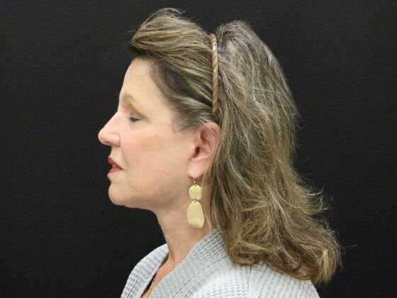 Face & Neck Lifts: Case 41 - After