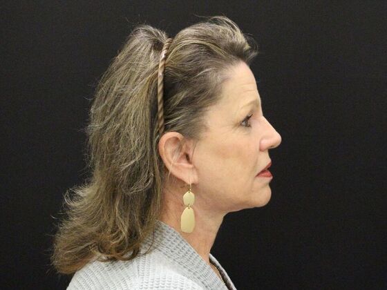 Face & Neck Lifts: Case 41 - After