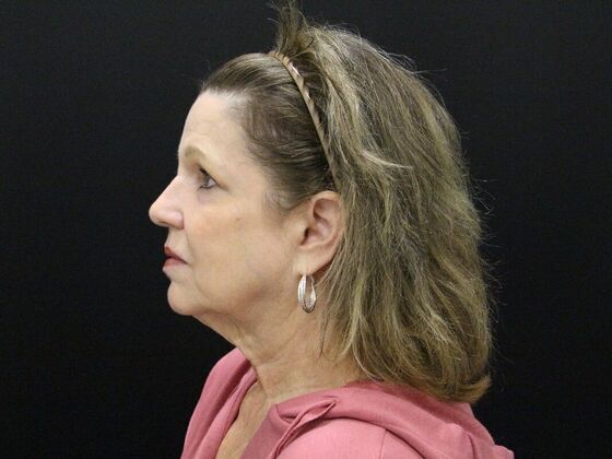 Face & Neck Lifts: Case 41 - Before