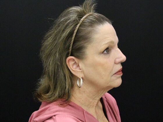 Face & Neck Lifts: Case 41 - Before
