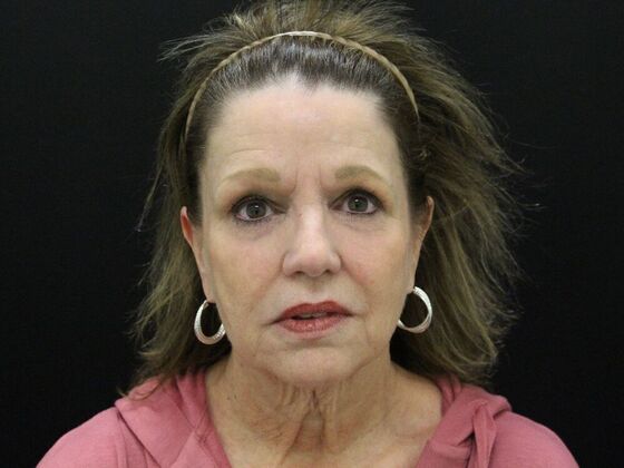 Face & Neck Lifts Case 41 - Before