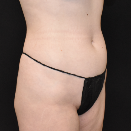 Liposuction: Case 3 - Before