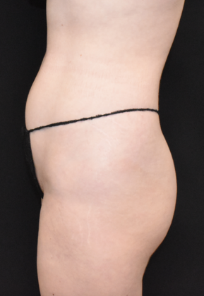 Liposuction: Case 3 - Before