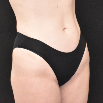 Liposuction: Case 3 - After