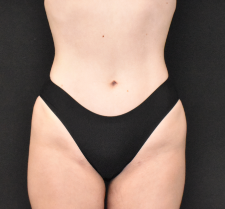 Liposuction Case 3 - After