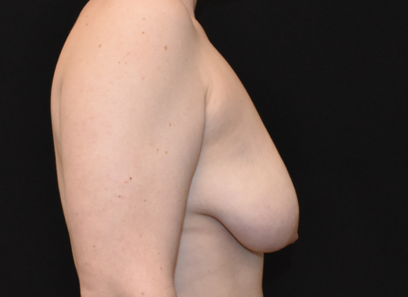 Mastopexy: Case 5 - Before