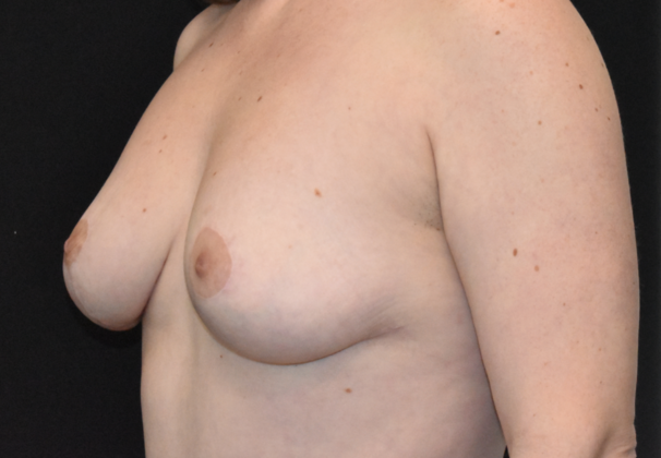 Mastopexy: Case 5 - After