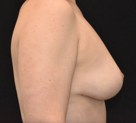 Mastopexy: Case 5 - After