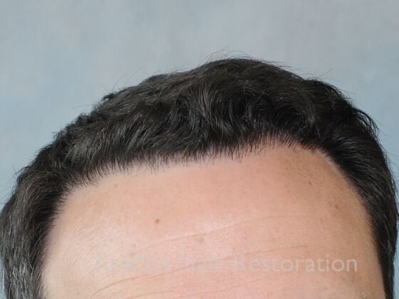 FUT Hair Restoration: Case 41 - After