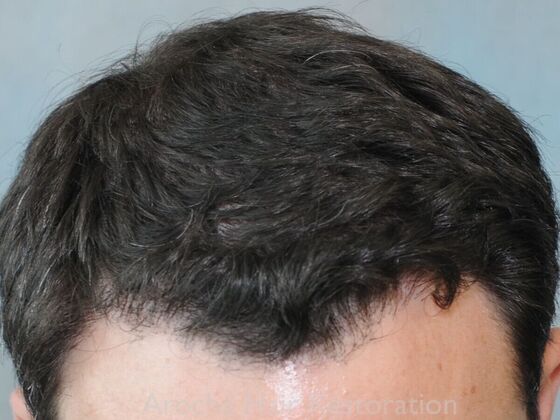 FUT Hair Restoration Case 41 - After
