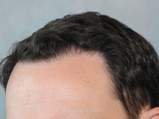 FUT Hair Restoration: Case 41 - After